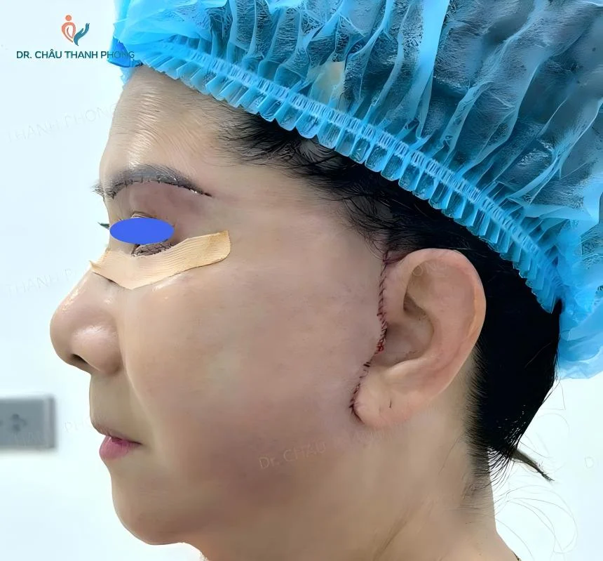 Thẩm mỹ khuôn mặt · BS. CKI. Châu Thanh Phong